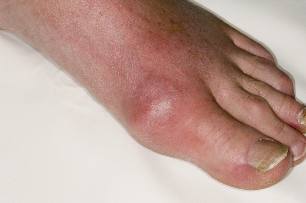 Gout of the big toe