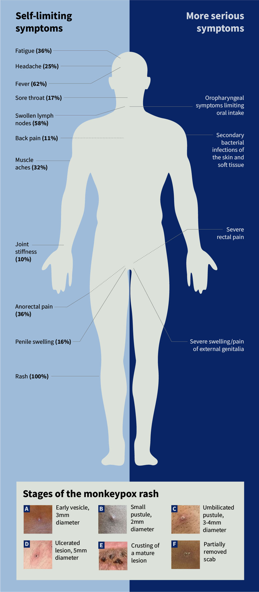 Figure 2: Monkeypox symptoms