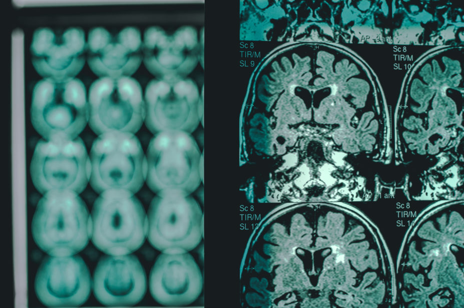 Alzheimer's disease on an MRI scan