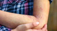 wounds atepic dermatitis in the hands of a child
