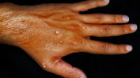 Monkeypox infection on hand