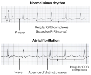 Atrial fibrillation: symptoms, diagnosis and management - The ...