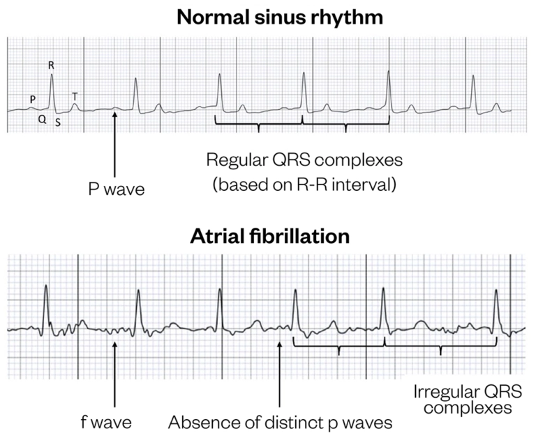 Atrial fibrillation: symptoms, diagnosis and management - The ...