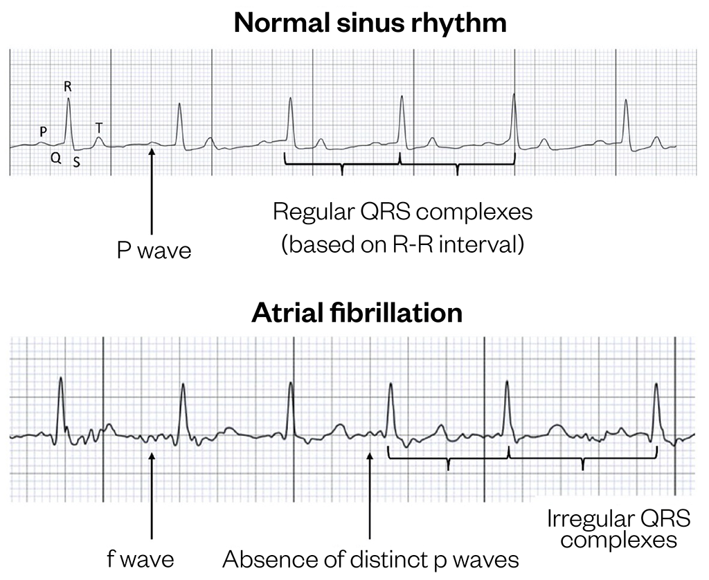 Figure 1: The key elements of an electrocardiogram recording indicating either normal sinus rhythm or atrial fibrillation.