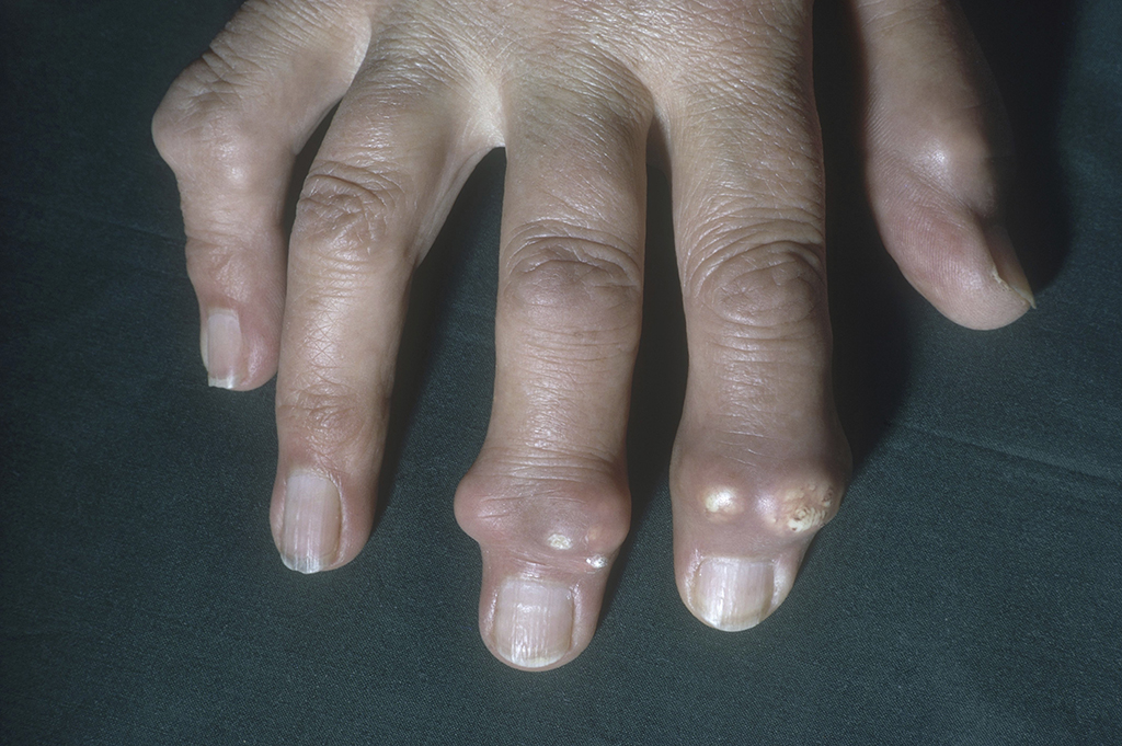 hand of someone with gout