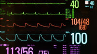 electrocardiogram showing bradycardia
