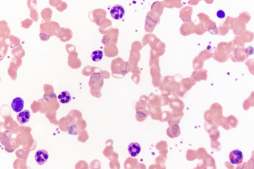 Blood smear, hypersegmented neutrophils, pernicious/megaloblastic anemia, iron deficient anemia, Wright's stain, 500X. Light micrograph