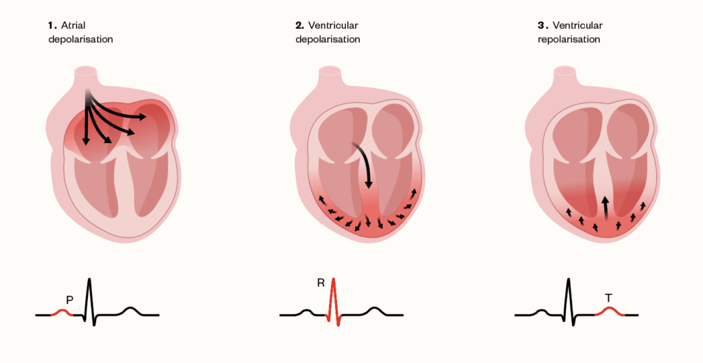 Figure 2: Heart excitation and representing atrial depolarisation and ventricular depolarisation as observed during digoxin toxicity (adapted from Safa et al.)