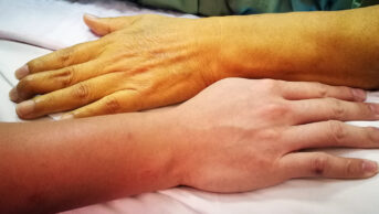 Jaundice patient with yellowish discoloration of skin in comparison