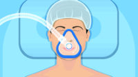 Illustration of a man wearing an anaesthetic mask