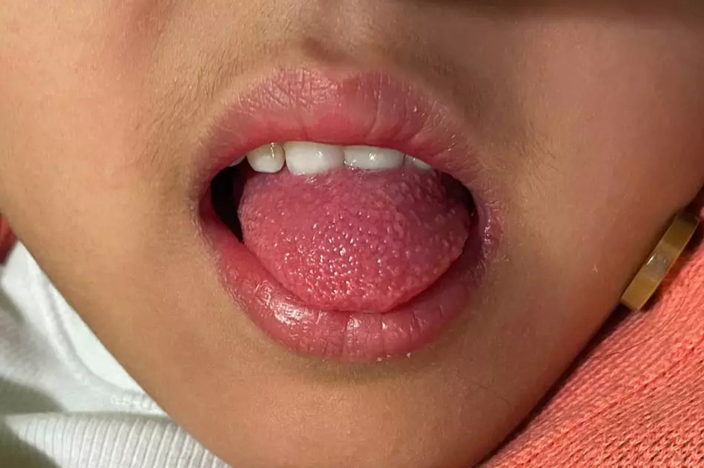 Child with strawberry tongue
