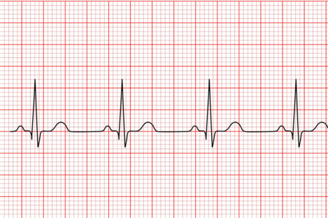 Interpretation of electrocardiograms - The Pharmaceutical Journal