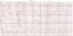 Interpretation of electrocardiograms - The Pharmaceutical Journal