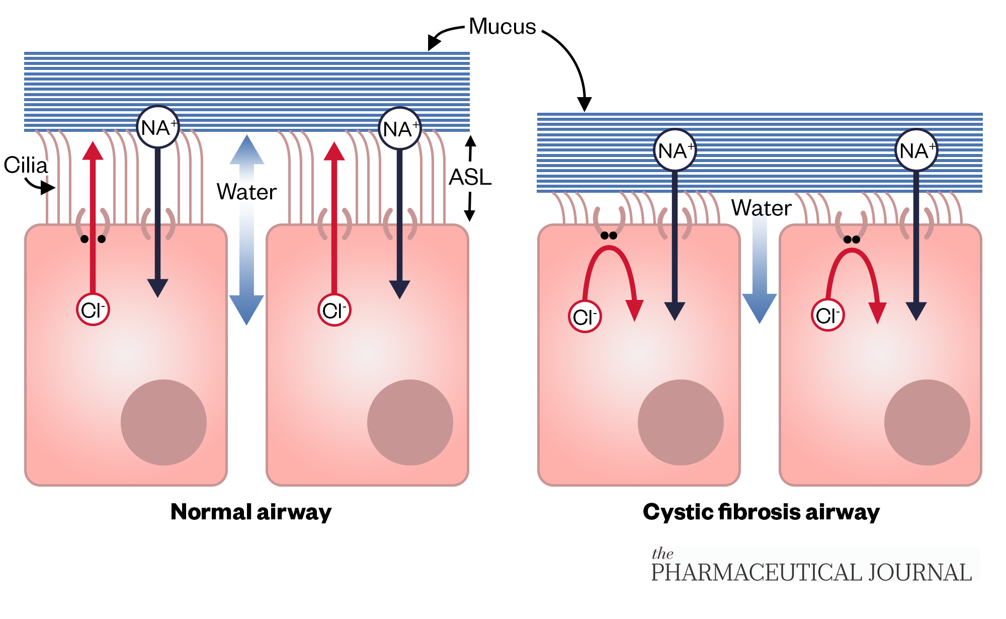 Diagram showing the difference in function of a normally functioning airway and that of a person with cystic fibrosis.