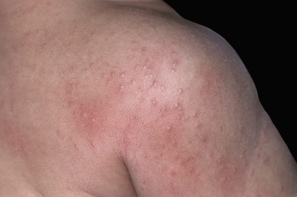 Close up image of heat rash on a 12 month old child.