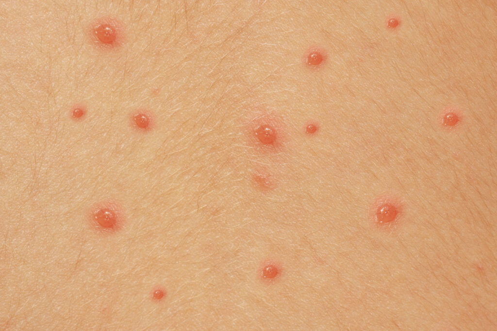 Photo of pox filling with fluid as they turn into blisters.