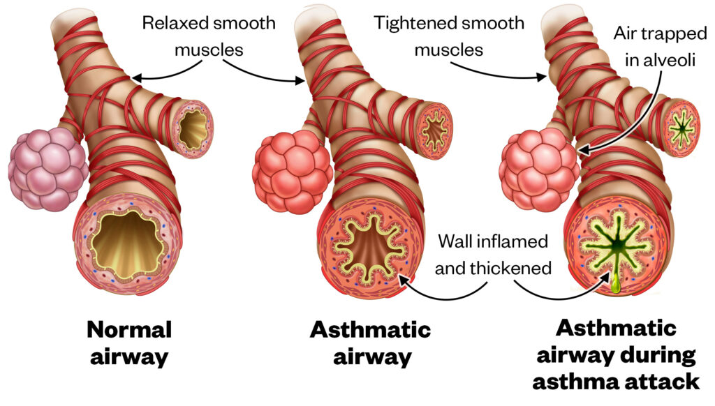 Illustration of a normal airway, asthmatic airway and asthmatic airway during an asthma attack, showing the inflamed and thickened walls, tightened smooth muscles and air trapped in the alveoli during the asthma attack