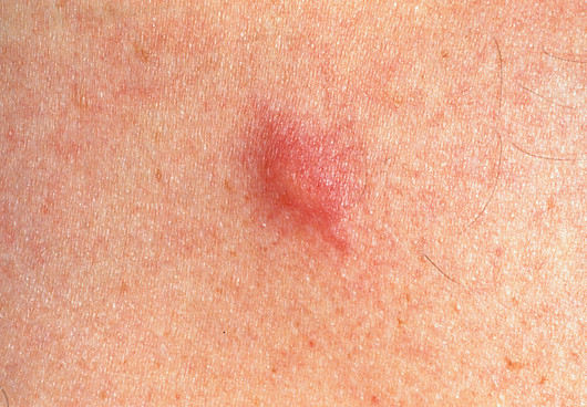 Close-up of a mosquito bite. 