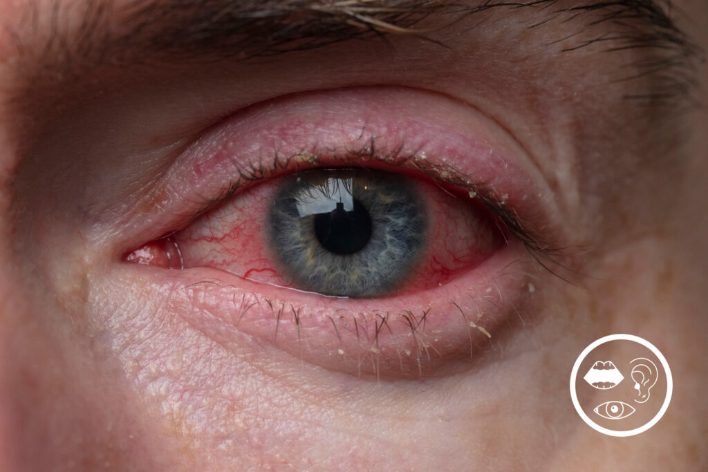 Photo close up of a sore red eye with conjunctivitis. 
