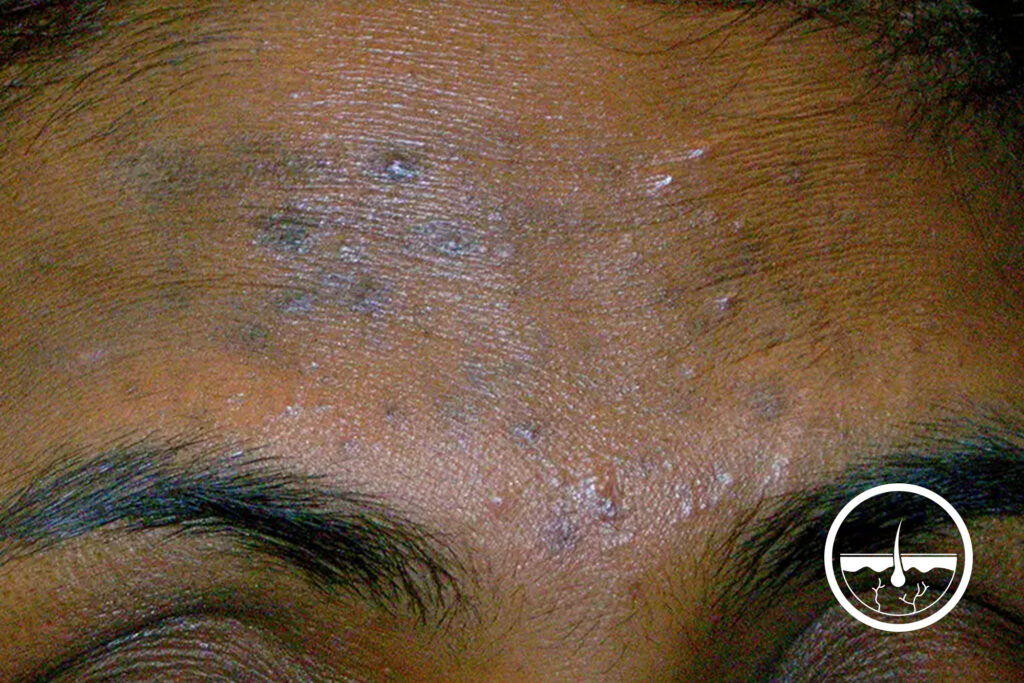 Close up of raised bumps on the forehead of a person with dark skin.