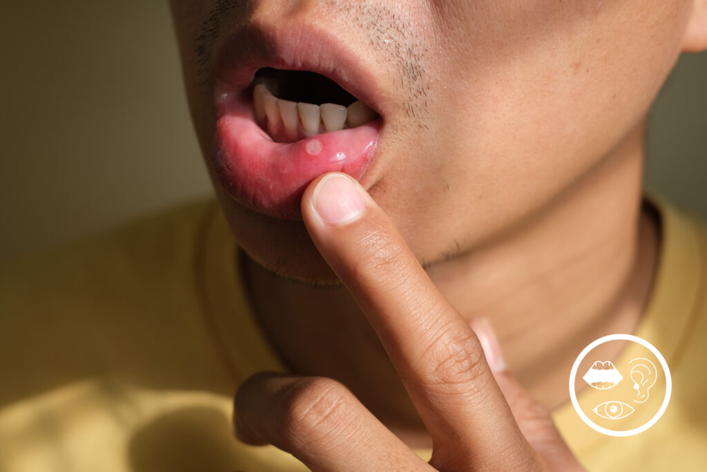 Photo of a young man pulling his lower lip down to reveal an ulcer.