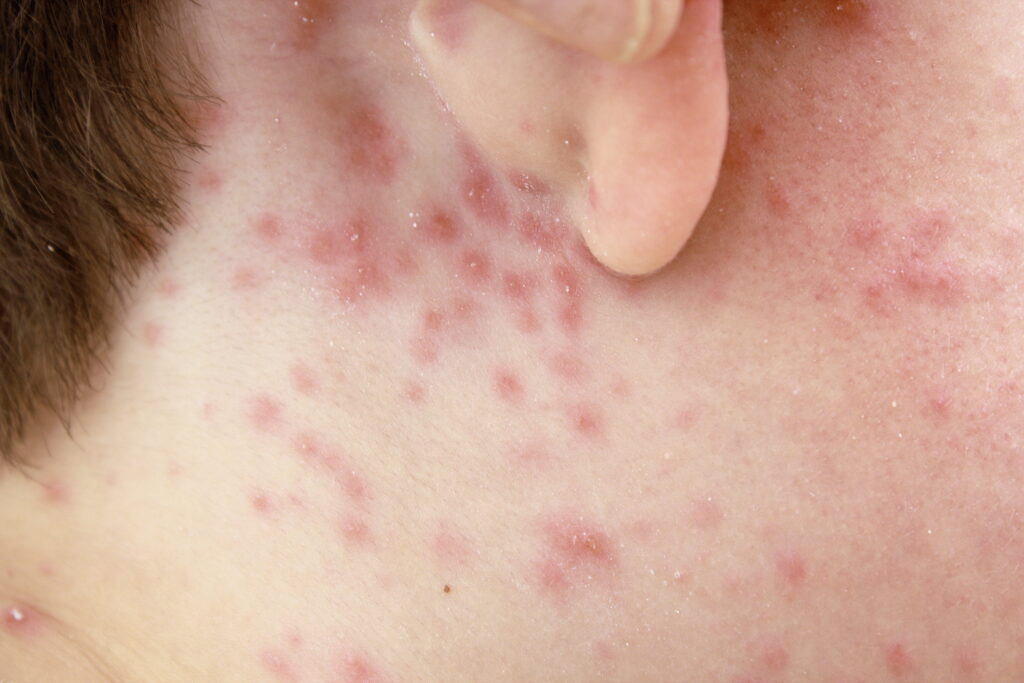 Photo of the initial stages of chicken pox, with raised red bumps on the skin, not yet blistering.