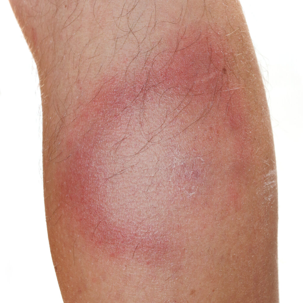 Red raised circular rash on the back of a leg.