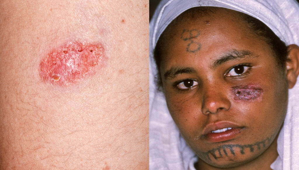 Close-up photos of cutaneous leishmaniasis lesions on white skin and skin of colour