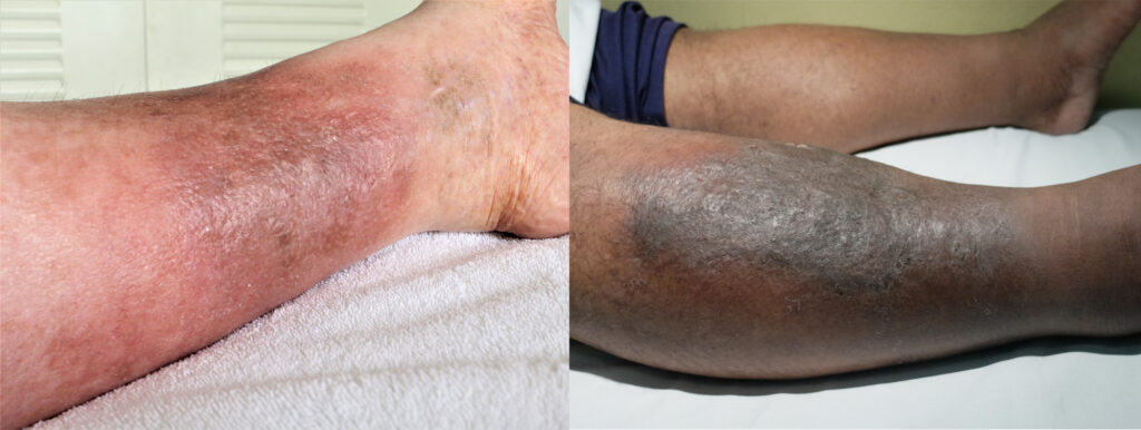 Photos of cellulitis in white skin and skin of colour