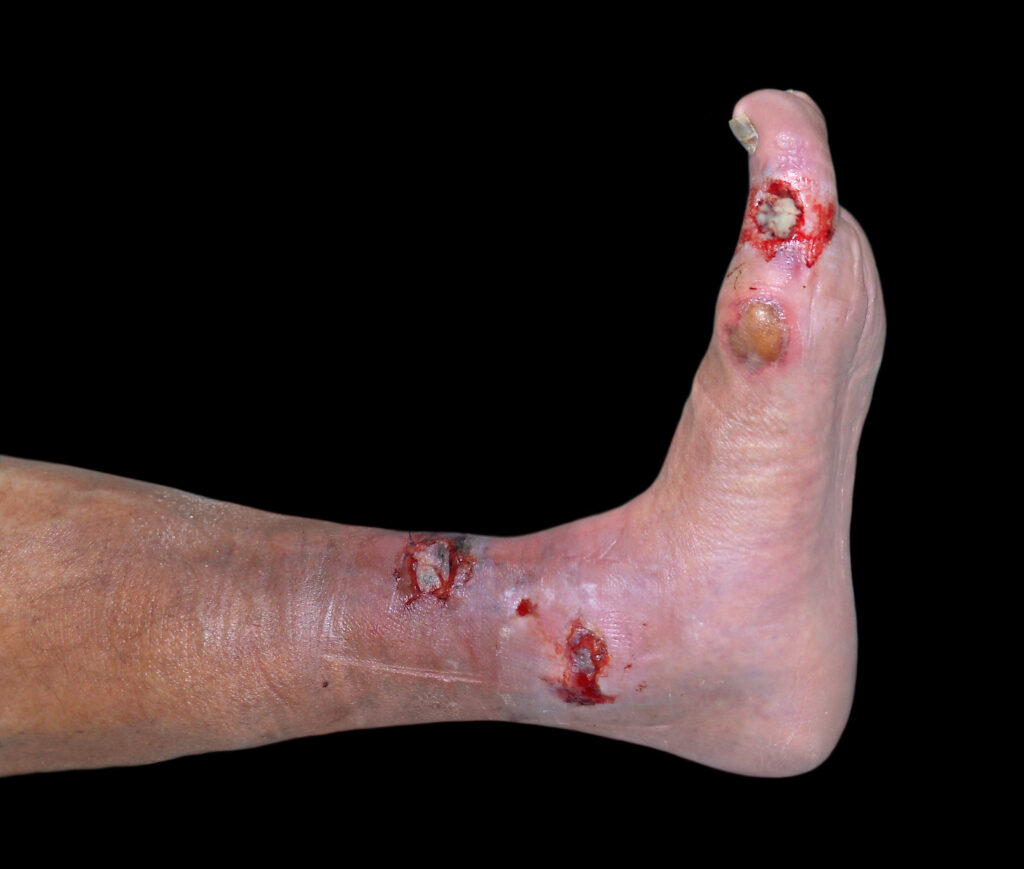 Photo of an ankle and foot with necrotising fasciitis 