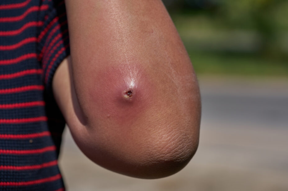 Close up image of an abscess on an elbow