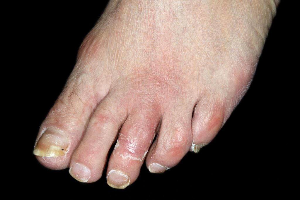 Photo of inflamed foot, due to cellulitis