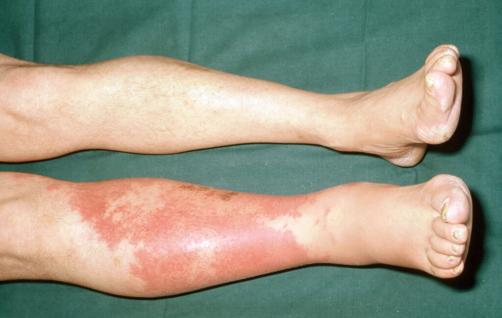 Cellulitis on lighter skin, lower left leg