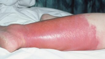 Photo of a pink and red inflamed lower leg