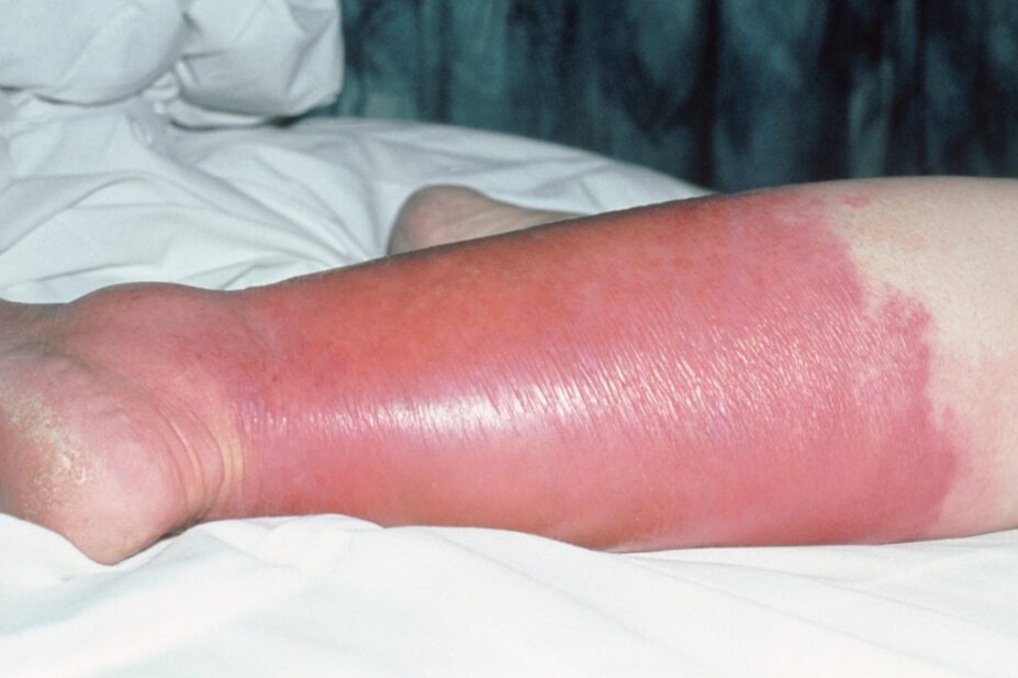 Photo of a pink and red inflamed lower leg