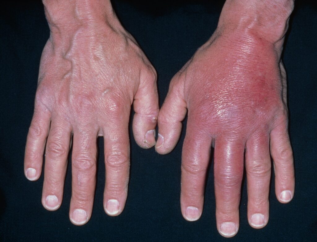Photo of a red and swollen inflammation of a hand due to cellulitis, next to an unaffected hand