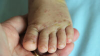 Baby's foot showing scabies lesions