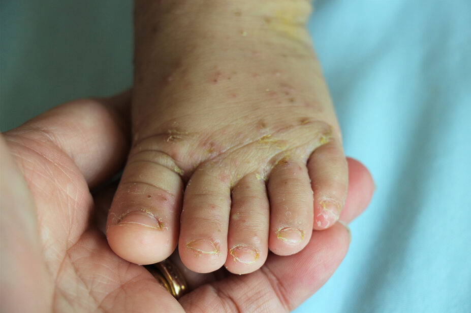 Baby's foot showing scabies lesions