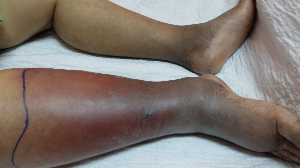 Photo of cellulitis on darker skin, lower left leg