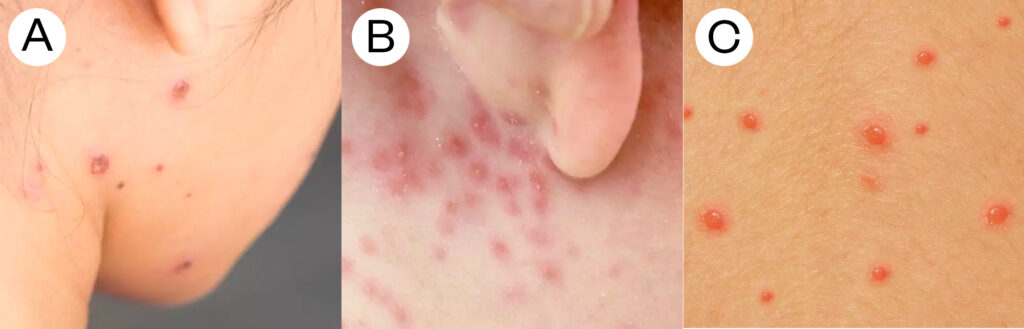 Photos of different stages of chickenpox