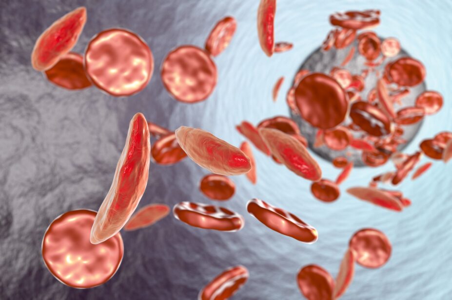 Artwork showing normal red blood cells (round), and red blood cells affected by sickle cell anaemia (crescent shaped).
