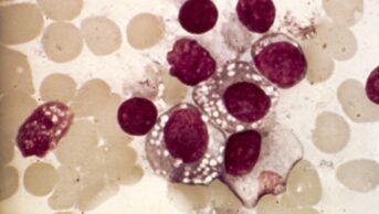 Lymphoplasmacytic lymphoma. Light micrograph of a mixture of lymphocytes and plasma cells with inclusions, from bone marrow, in a case of lymphoplasmacytic lymphoma, also known as Waldenstrom's macroglobulinemia. This cancer affects B cell lymphocytes, a type of white blood cell. It is named for the resemblance the abnormal cells have to plasma cells, resulting in them being termed plasmacytoid lymphocytes. The white blood cells are stained purple, with the red blood cells appearing a pale orange.