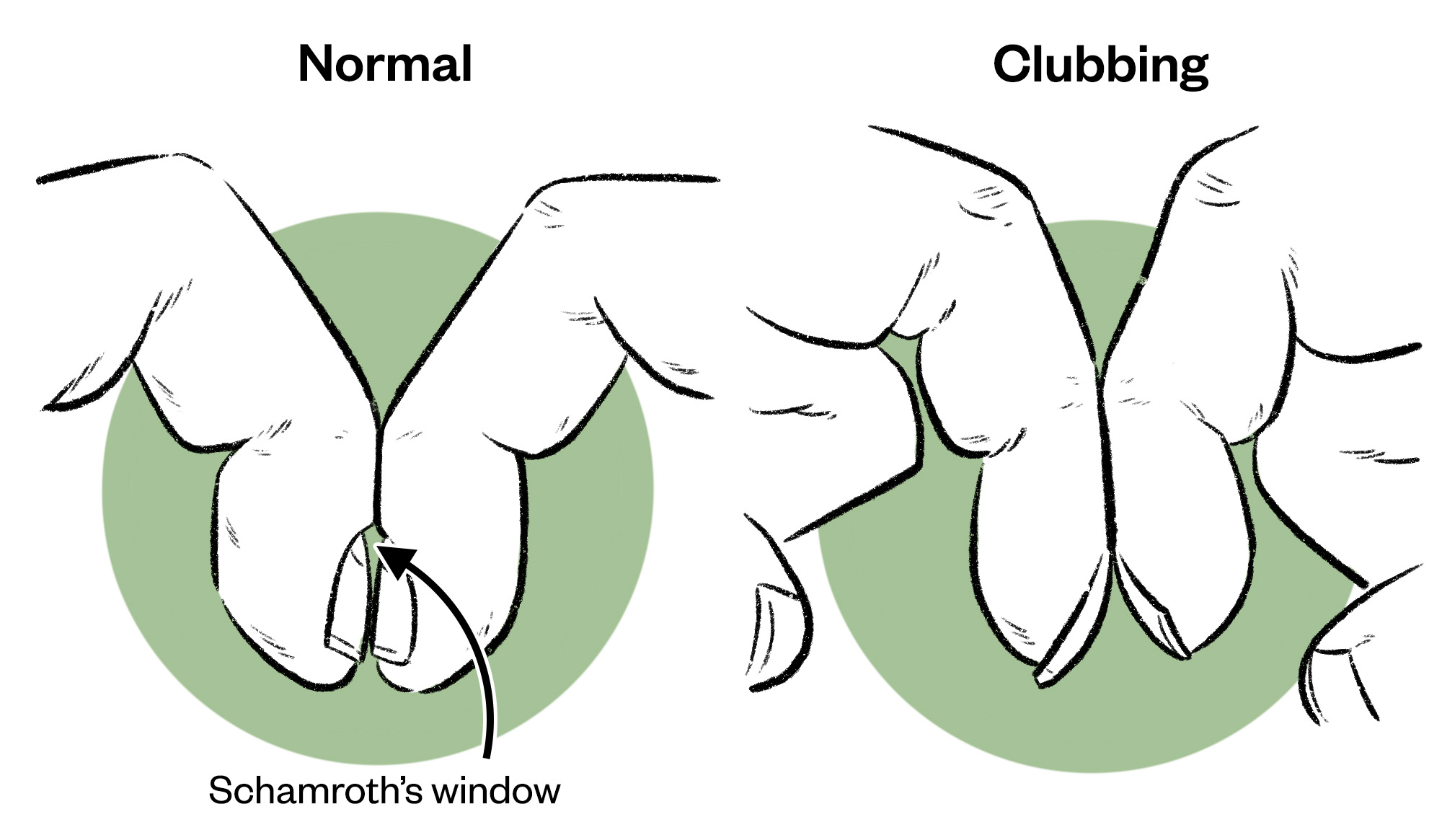 Illustration showing the gap between healthy fingers brought together in a claw shape and the lack of gap where clubbing has occurred. 