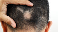 man with hair loss near base of scalp