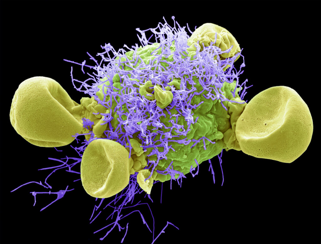 Scanning electron micrograph (SEM) of a HEp2/HeLa cell (Human epithelial cell line) infected with RSV A (Strain Long).