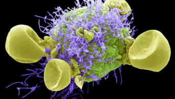 Scanning electron micrograph (SEM) of a HEp2/HeLa cell (Human epithelial cell line) infected with RSV A (Strain Long).