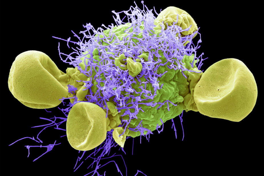 Scanning electron micrograph (SEM) of a HEp2/HeLa cell (Human epithelial cell line) infected with RSV A (Strain Long).