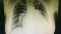 Abnormal chest x-ray , showing cardiomegaly , pulmonary hypertension , right sided heart failure