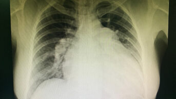 Abnormal chest x-ray , showing cardiomegaly , pulmonary hypertension , right sided heart failure