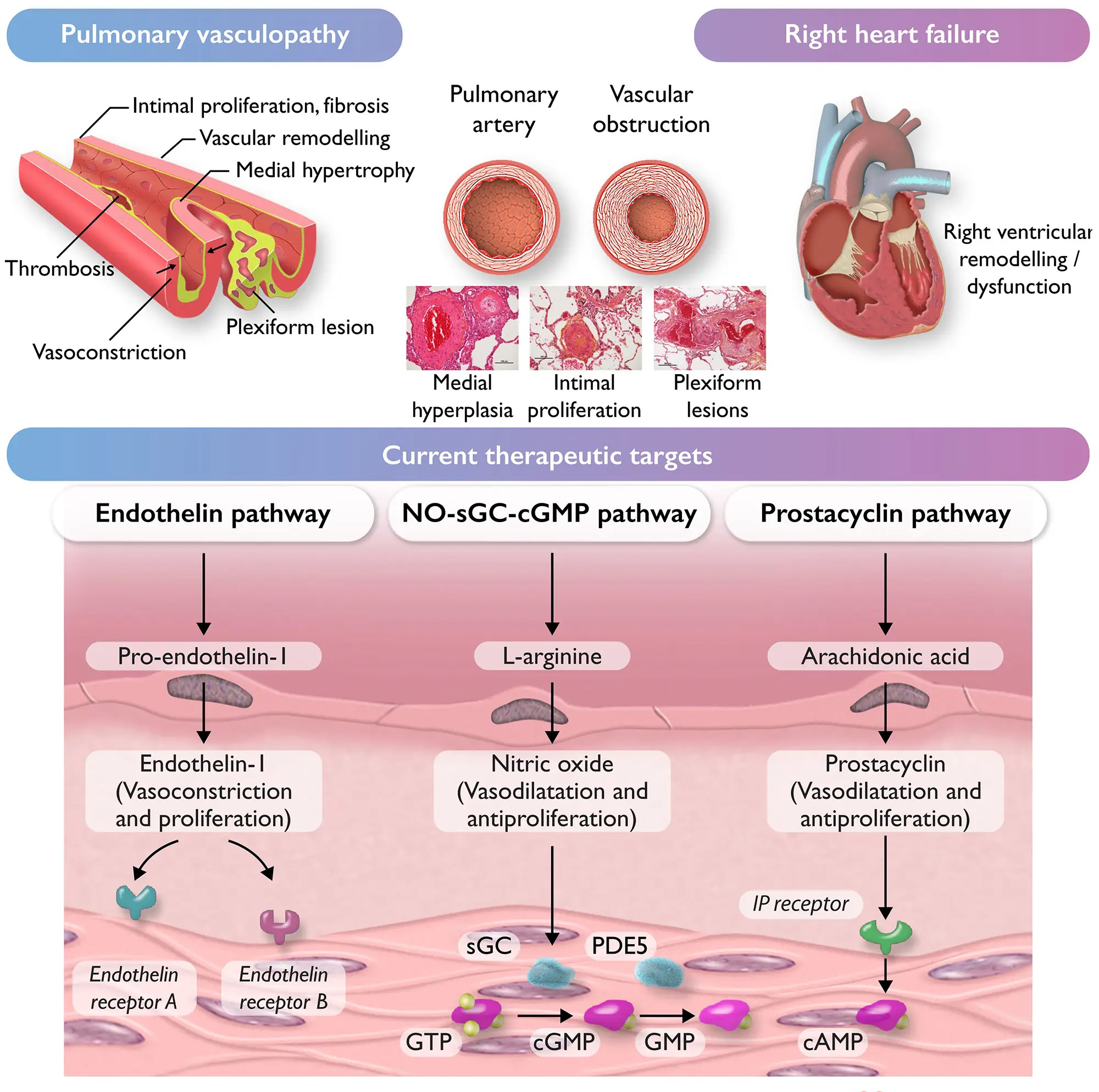 Diagram showing pulmonary hypertension effects and therapeutic targets